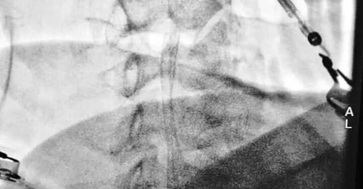 مستشفى الشهيد غازي الحريري للجراحات التخصصية يجري عملية قسطارية مميزة لمريض يبلغ من العمر 70 عاما يعاني من جلطات دماغية متكررة