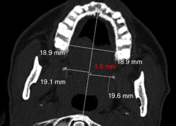 جراحة تنهي معاناة مريضة من آلام مزمنة في الوجه والبلع استمرت لسنوات بـ”سعود الطبية”
