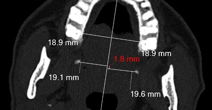 جراحة تنهي معاناة مريضة من آلام مزمنة في الوجه والبلع استمرت لسنوات بـ”سعود الطبية”