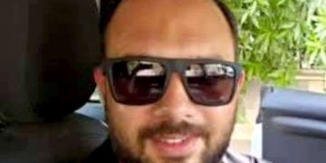 د. عمرو أيمن يبتكر تقنية لشد الوجه بمخدر موضعي وبدون جروح