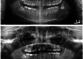 مدينة الملك سعود الطبية تحقق إنجازًا طبيًّا عالميًّا بتقنية مبتكرة لعلاج الأورام الكيراتينية الفكية