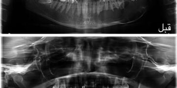 مدينة الملك سعود الطبية تحقق إنجازًا طبيًّا عالميًّا بتقنية مبتكرة لعلاج الأورام الكيراتينية الفكية