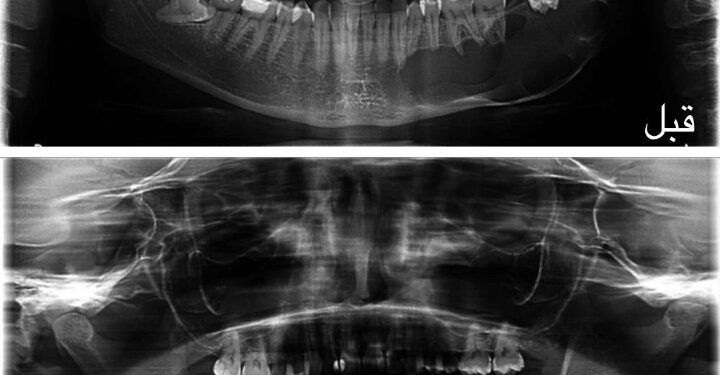 مدينة الملك سعود الطبية تحقق إنجازًا طبيًّا عالميًّا بتقنية مبتكرة لعلاج الأورام الكيراتينية الفكية