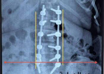 مستشفي يجري عملية معقدة لتصحيح اعوجاج العمود الفقري القطني لمريضة بعمر 50 عام