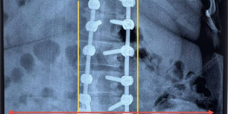 مستشفي يجري عملية معقدة لتصحيح اعوجاج العمود الفقري القطني لمريضة بعمر 50 عام