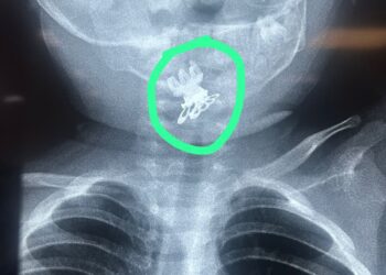 استخراج مشبك شعر (قرّاصه)من مجرى التنفس لطفلة بعمر سنة ونصف في مدينة الصدر الطبية