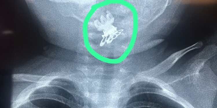 استخراج مشبك شعر (قرّاصه)من مجرى التنفس لطفلة بعمر سنة ونصف في مدينة الصدر الطبية